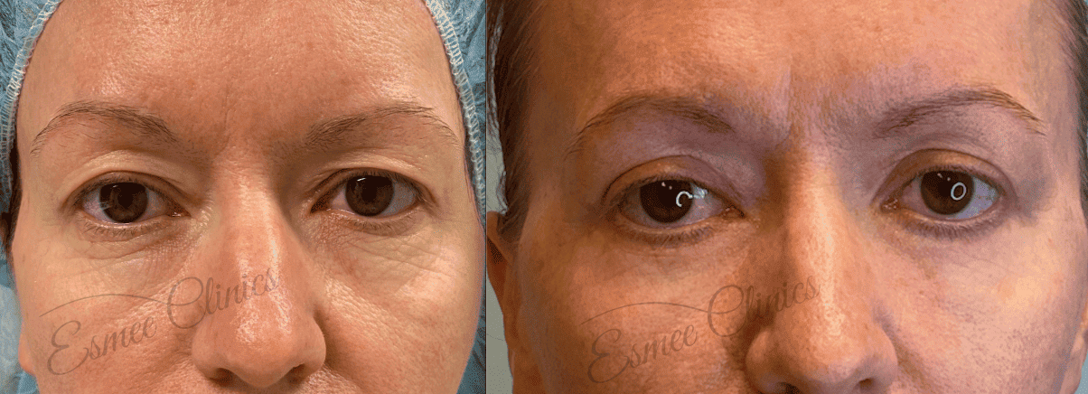 Before and After img